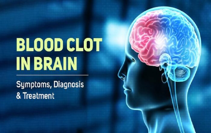 How to remove blood clot in brain without surgery?