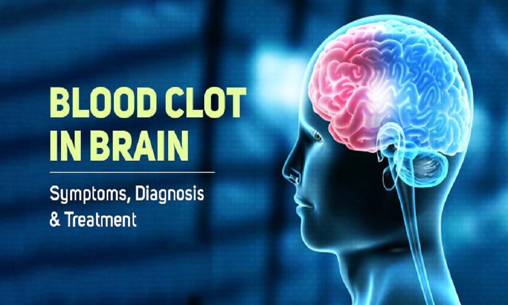 How to remove blood clot in brain without surgery?